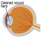 cataract