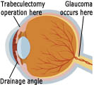 Glaucoma